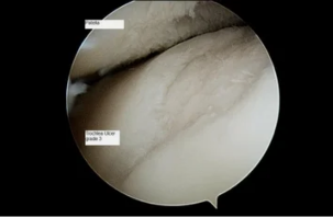 vaizdas astroscope į kelis bendras su osteoartritas 3-ojo laipsnio