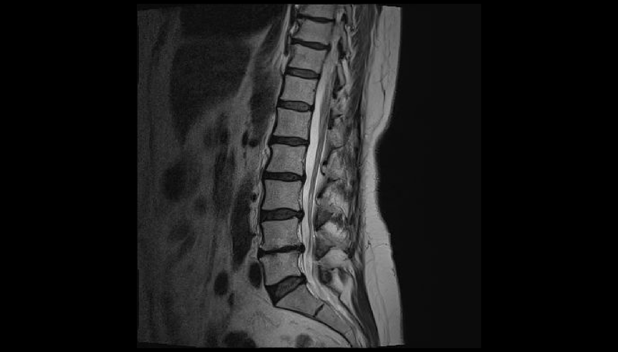 nugaros skausmo juosmens srityje diagnostika