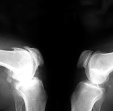 Osteoartritas į x-ray