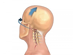 kaip pasireiškia kaklo stuburo osteochondrozė