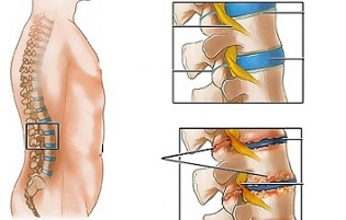 juosmens stuburo dalies osteochondrozės priežastys