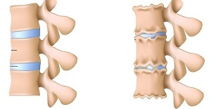 kaip atpažinti juosmens stuburo osteochondrozę