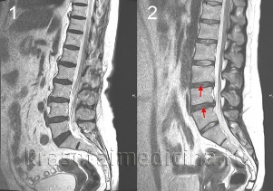 osteochondrosis stuburo