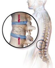 Osteoporozė išprovokuoja nugaros skausmus juosmens srityje